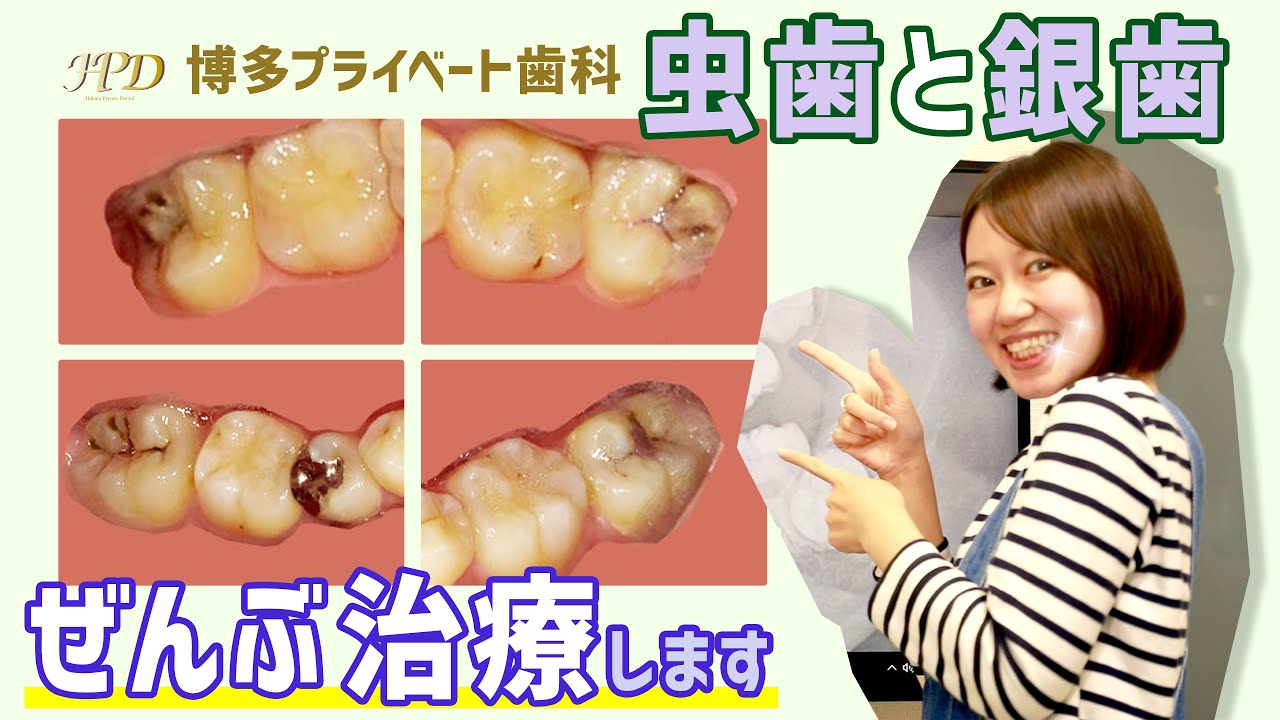 奥歯の虫歯治療とセラミックインレーSET！博多プライベート歯科でお悩みを解決！