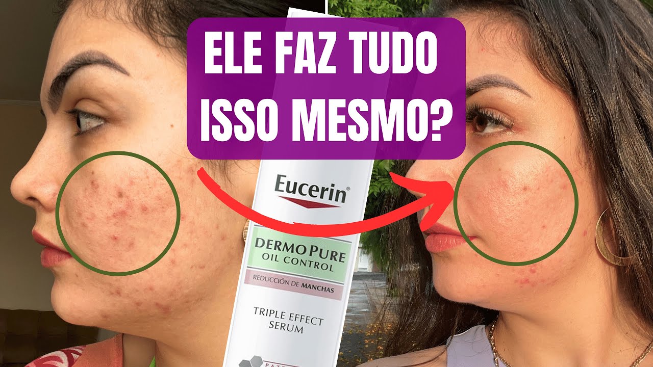 RESENHA EUCERIN DERMOPURE EFEITO TRIPLO PARA ACNE, OLEOSIDADE E MARCAS ESCURAS PÓS ACNE