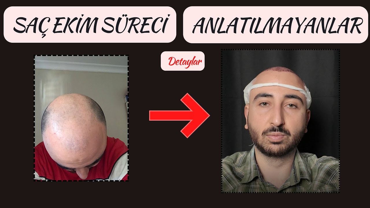 SAÇ EKİMİ DETAYLAR ve ANLATILMAYANLAR