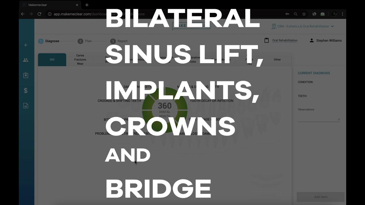 Presenting Sinus Lift, Implants, Crowns and Bridge using MakeMeClear Software