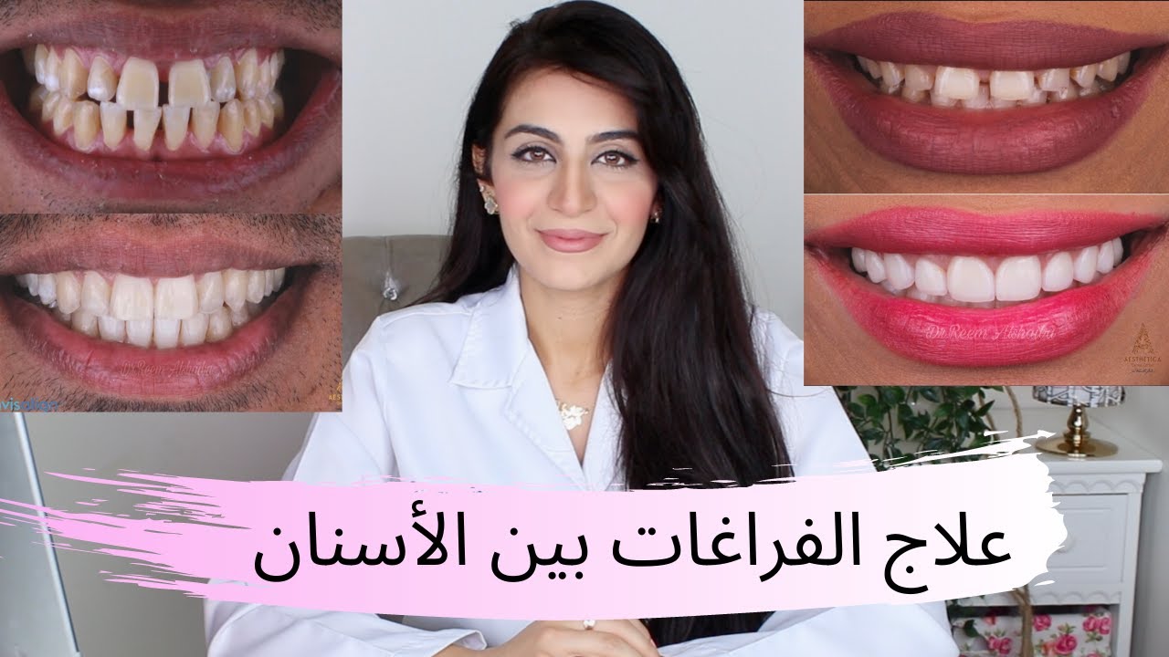 علاج الفراغات بين الأسنان