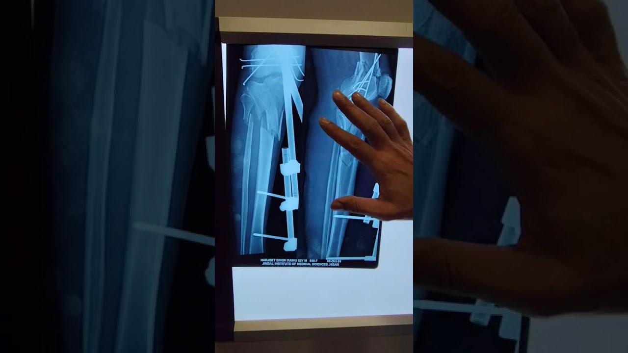 Treatment of multiple Fractures in Road Accident