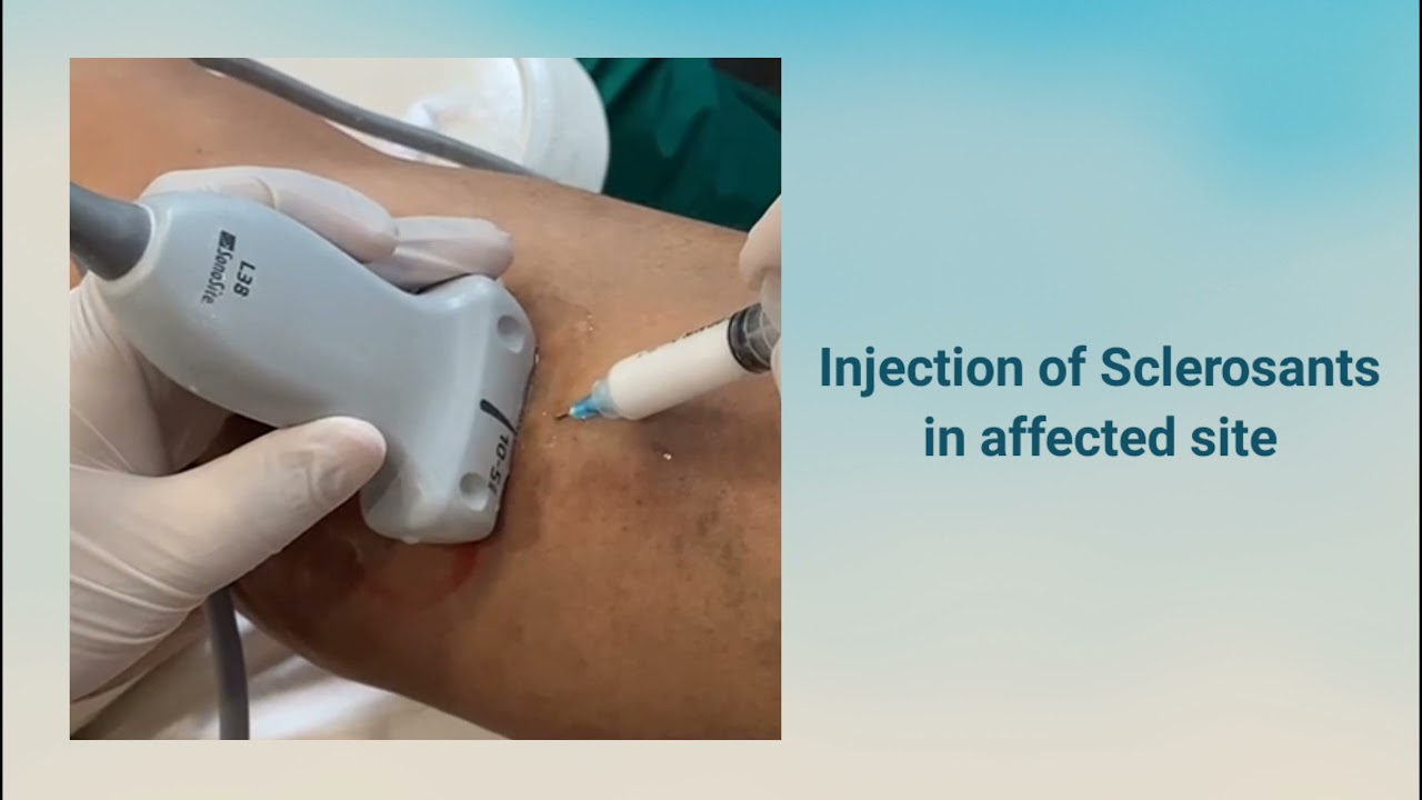 Sclerotherapy for Venous Malformation