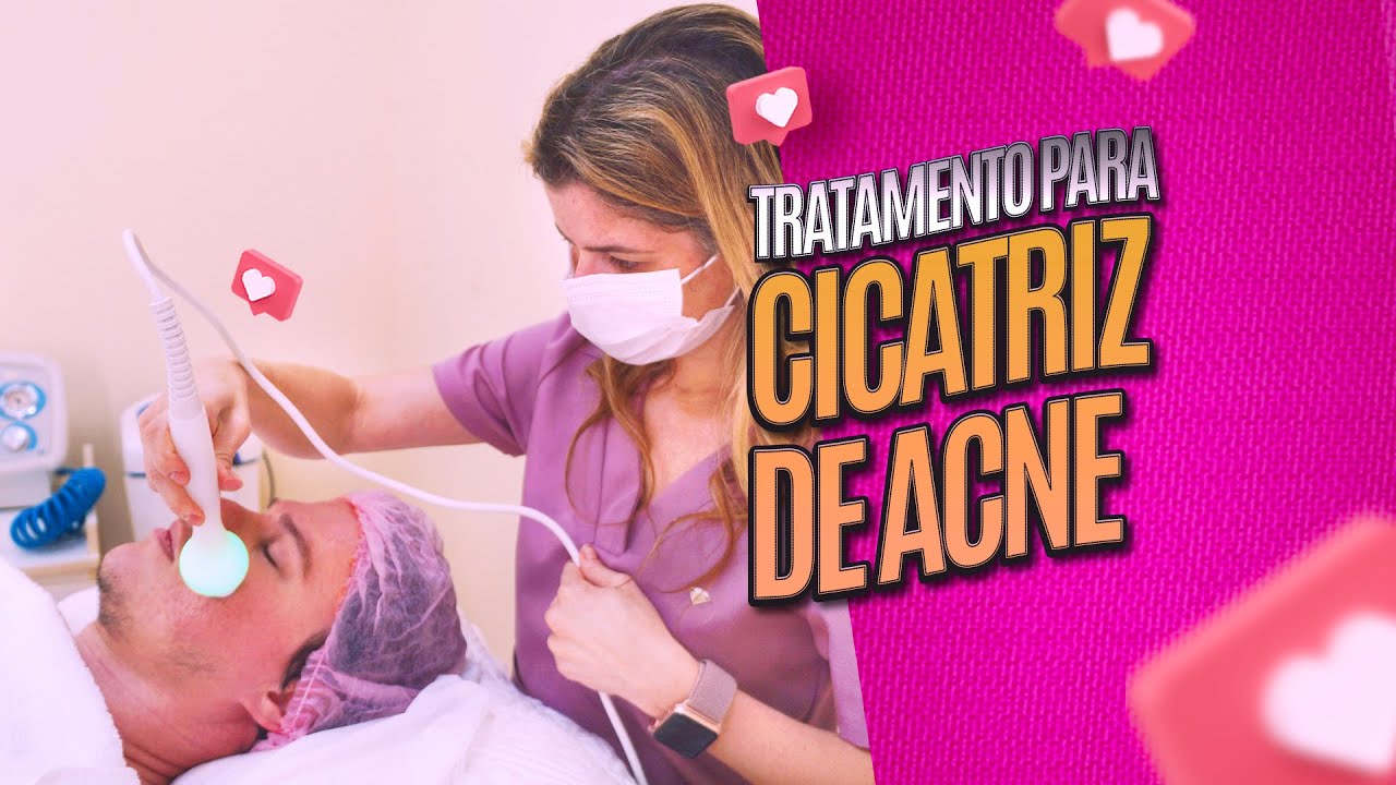 Tratamento para reduzir cicatriz de acne