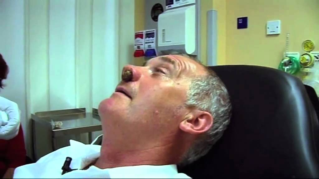 Stuffed Nose - Bizarre ER