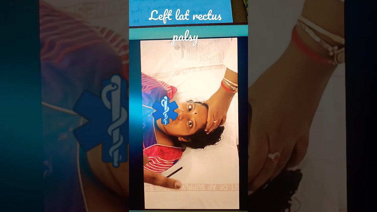 Left lateral rectus palsy