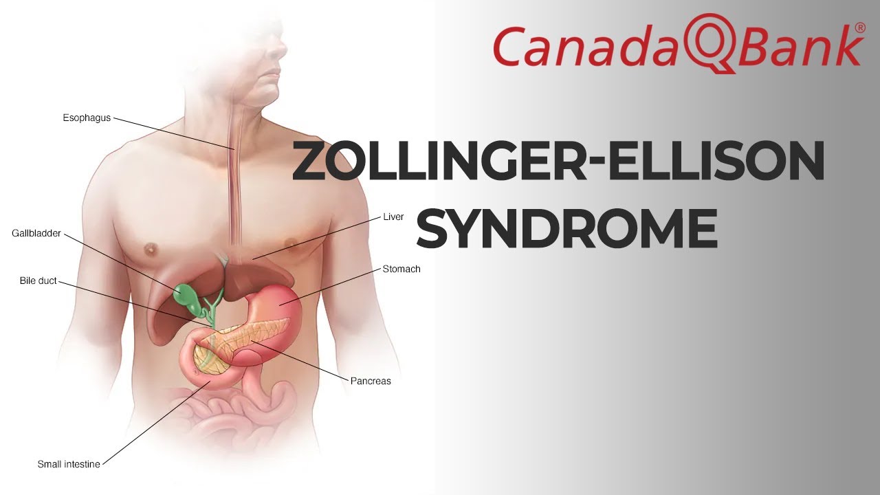 Zollinger–Ellison Syndrome Explained | Gastrinoma, Diagnosis & Treatment | CanadaQBank