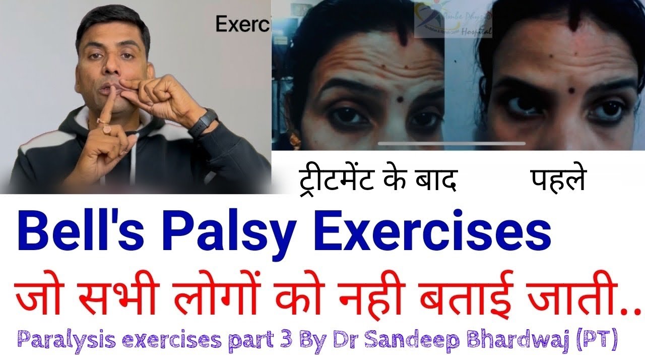 Bell’s palsy exercises, आधे चेहरे का लकवा? || Facial paralysis exercise @Drsandeepbhardwaj