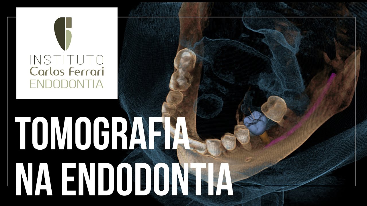 Tomografia na Endodontia - 1ª parte. Introdução.