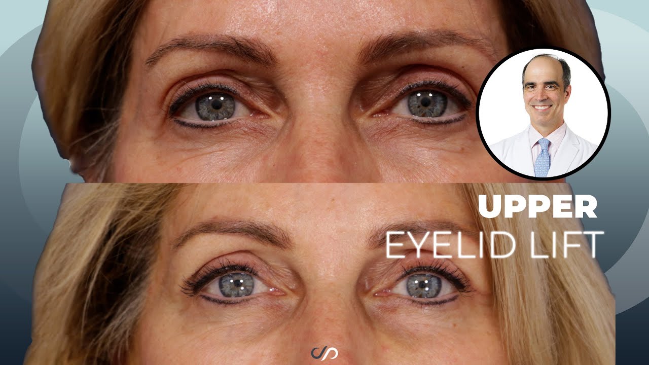 How to Get a More Natural Looking Upper Eyelid | Dr. David Stoker