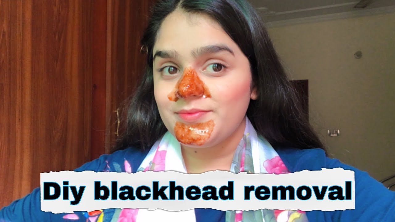 How to remove blackheads at home || Diy blackhead removal