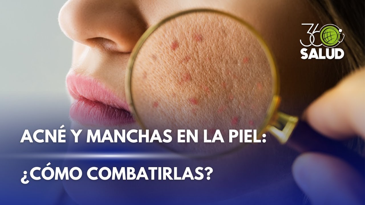 ACNÉ Y MANCHAS: LO QUE NADIE TE EXPLICA SOBRE SU TRATAMIENTO
