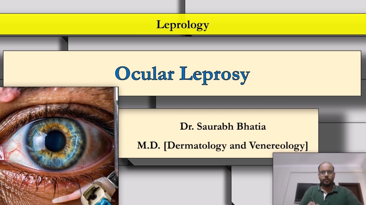 Ocular  Leprosy: Eye involvement; grading; features