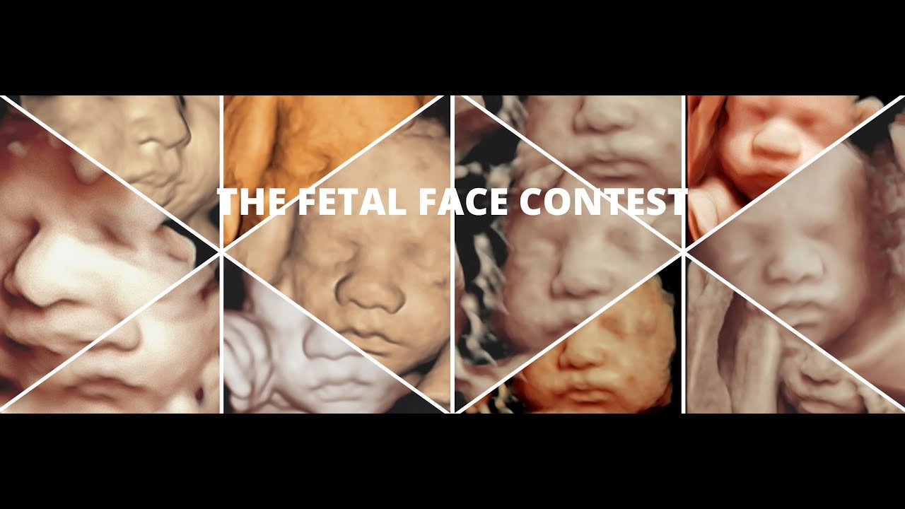 The Fetal Face Contest at Sonobuzz 2019