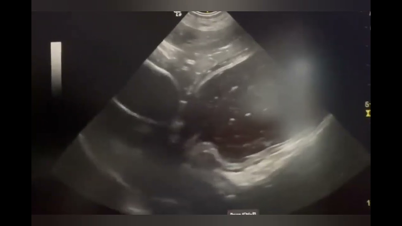 Sonographic feature of stomach obstruction #sonography #stomach #obstruction 