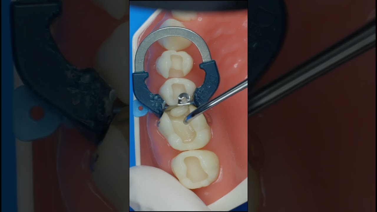 Resina Composta Classe II 