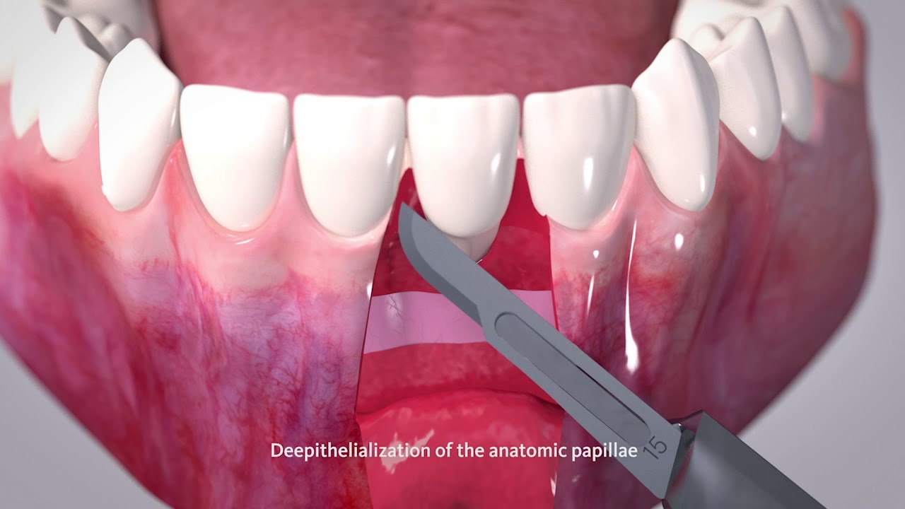 Root coverage of a single recession defect - 3D Animated Video