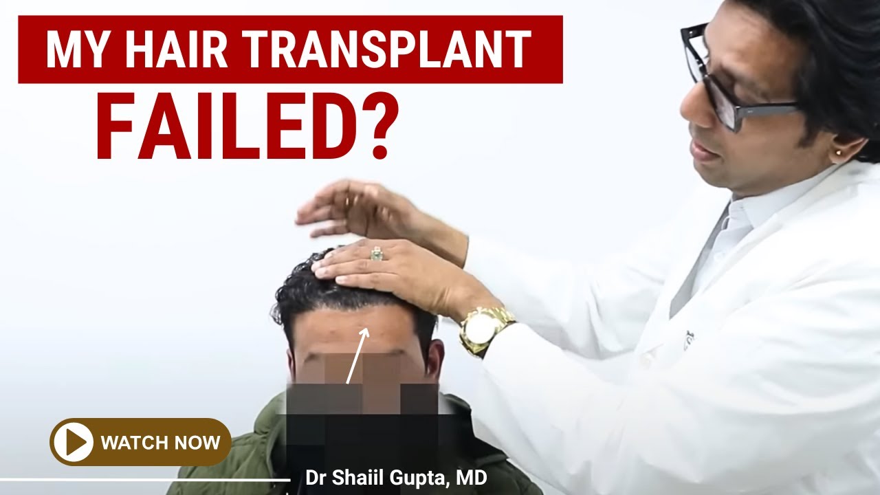 Repair Hair Transplant Satya | Repair Hair Transplant | Best Hair Transplant Satya | Satya Clinic