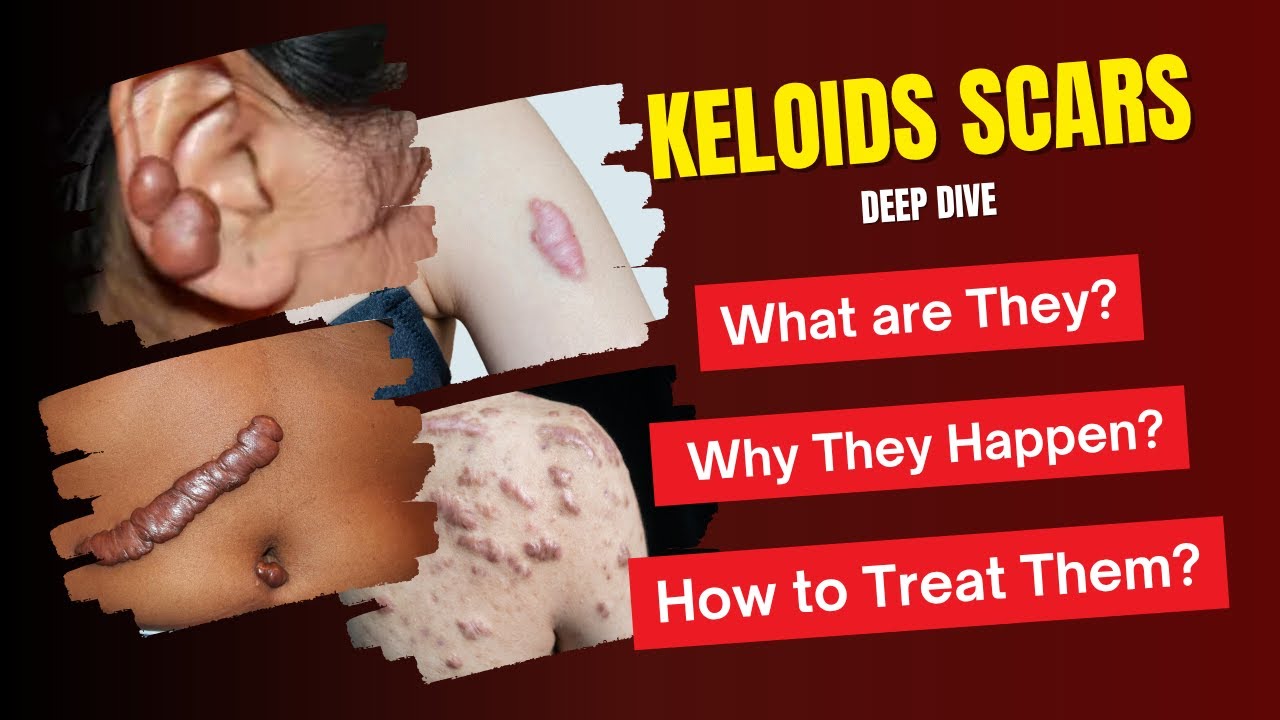 Keloids Scars Deep Dive | What are They? |  Why They Happen? | How to Treat Them?