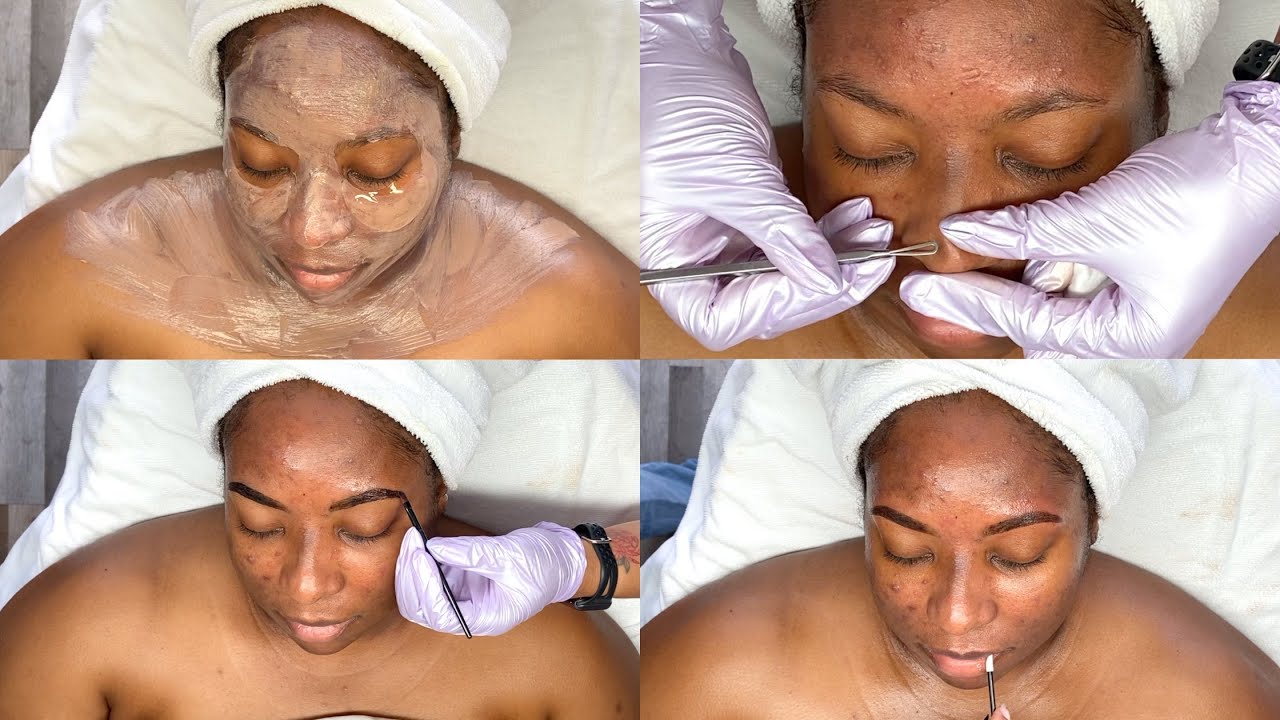Acne scars & Blemish Brightening + Clearing Facial