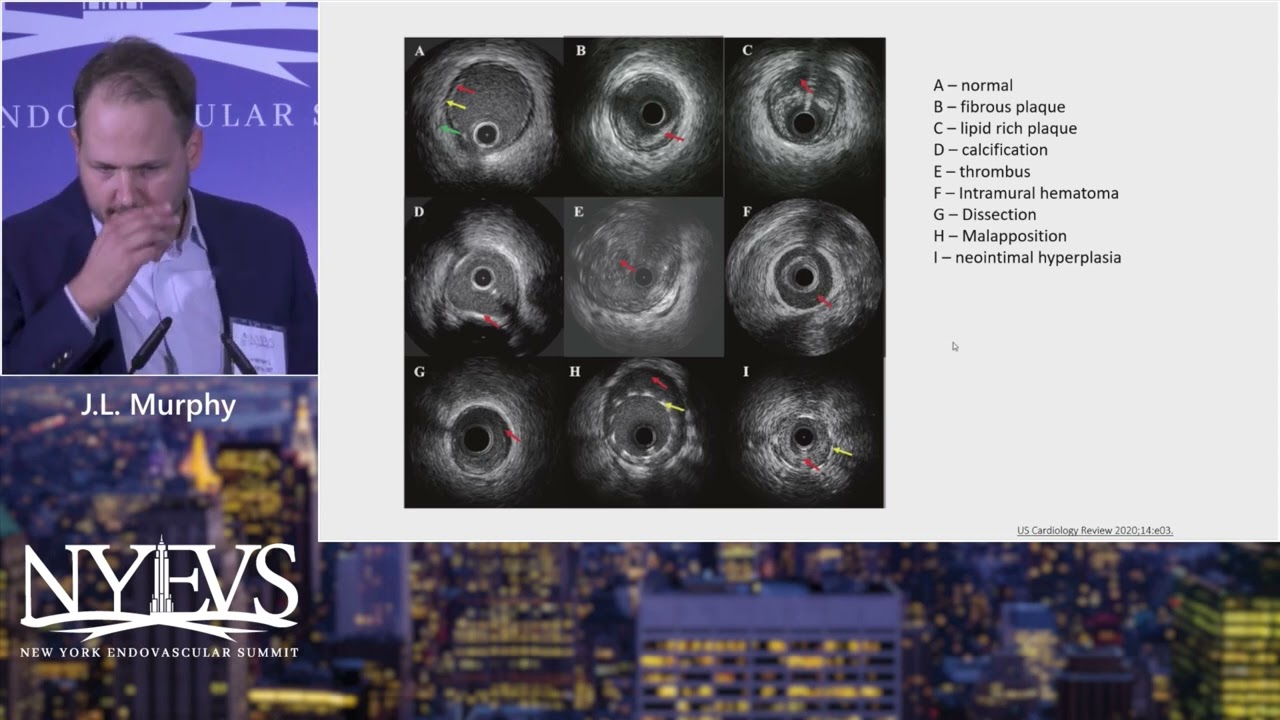 Intravascular Imaging IVUS in PAD   J  L  Murphy   ACP Nurse Session