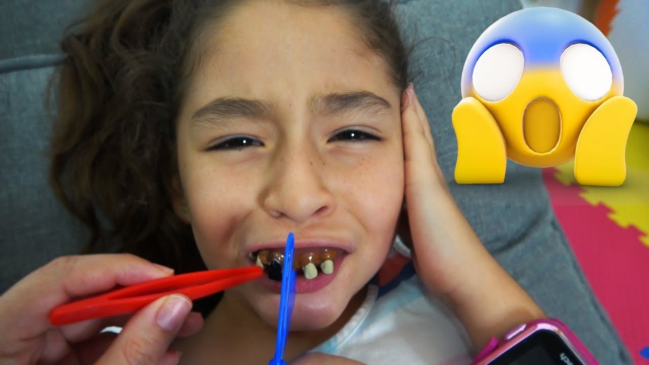 LE SALE CARIES POR COMER MUCHOS DULCES Y NECESITA UN DENTISTA URGENTE | LA CARIES v2 // YESLY