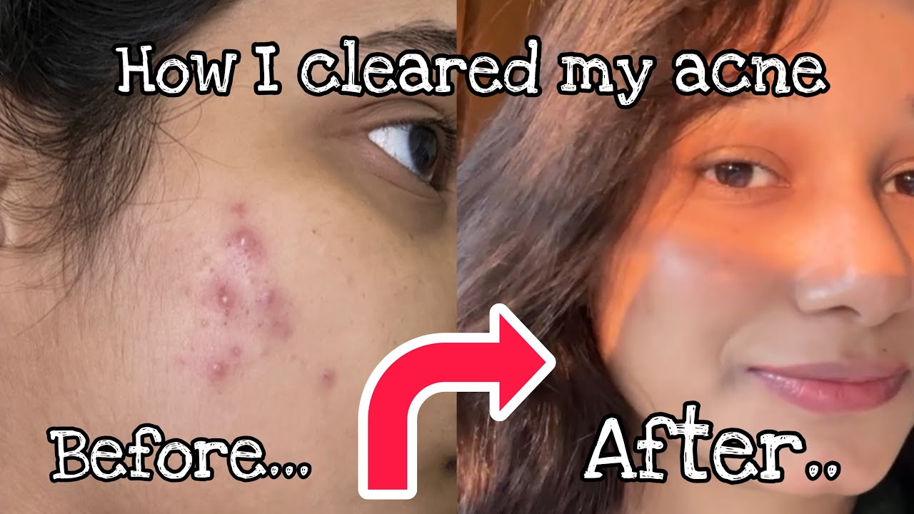 How I cleared my acne ~ Tips, routine and mistakes