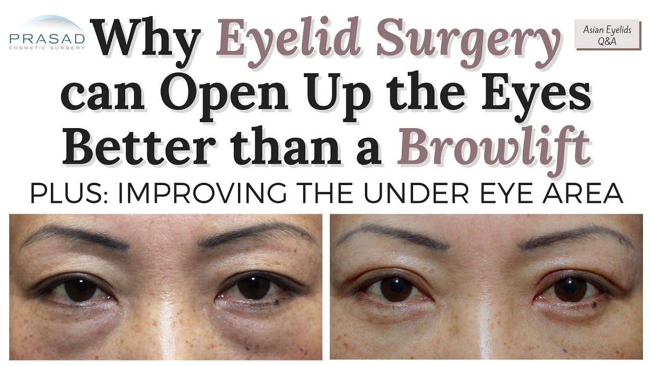 How Asian Double Eyelid Surgery can Open up the Eyes More Naturally than a Brow Lift