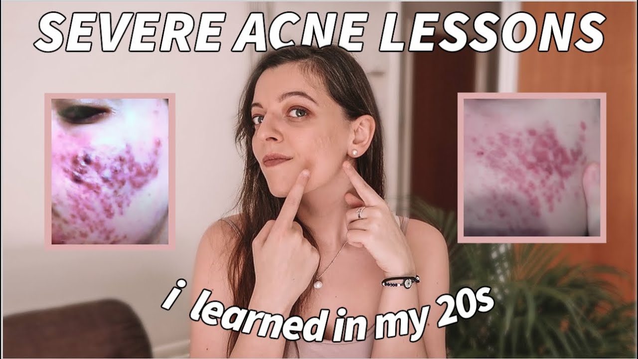 ACNE POSITIVITY | Lessons my ADULT SEVERE ACNE taught me (i never had acne until 20)