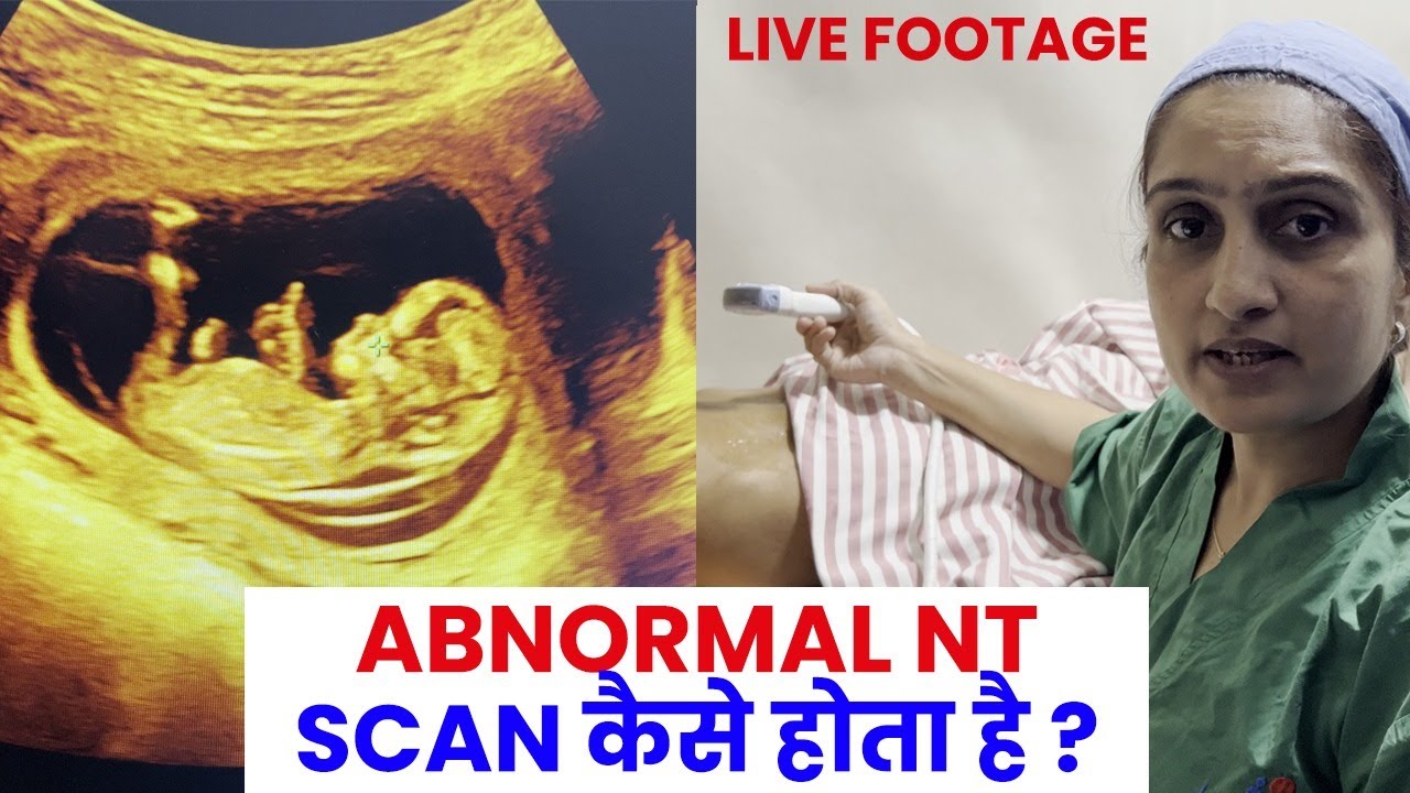 Abnormal NT Scan | Nuchal translucency (NT) scan | Live demo -Dr Asha Gavade