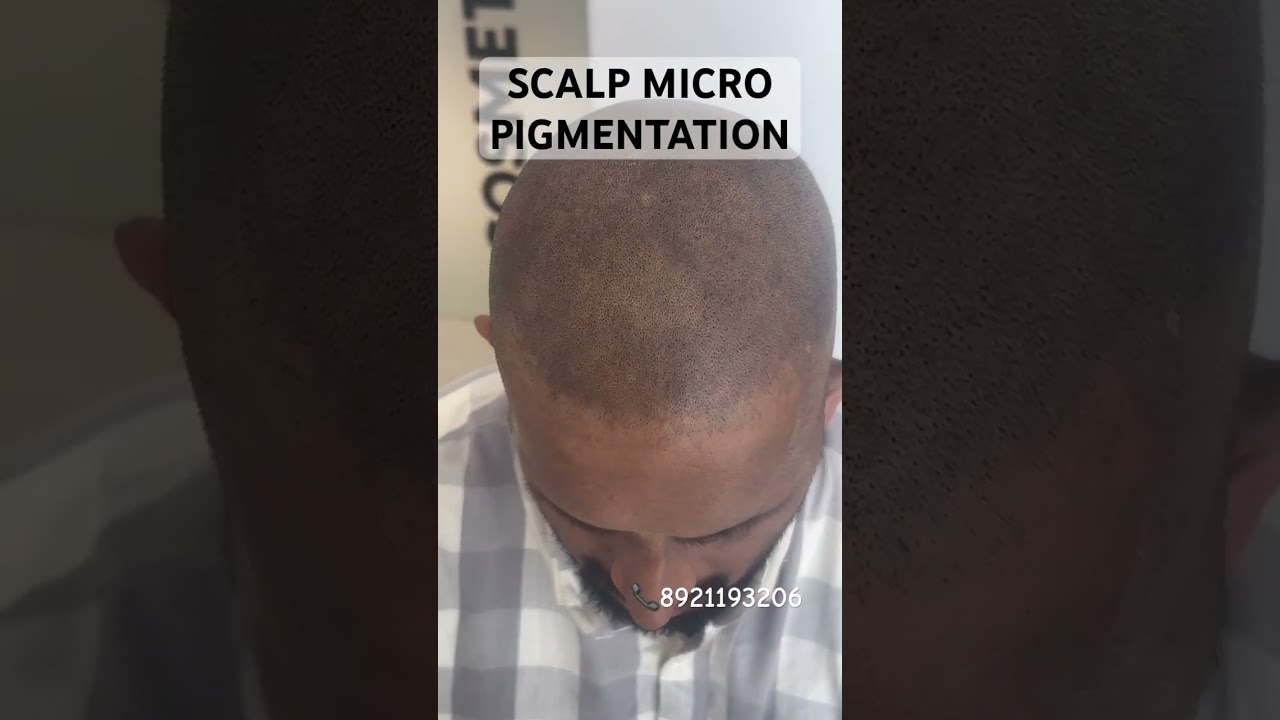 SCALP MICRO PIGMENTATION for trimmed hair look appearance for those who has less scalp hair density