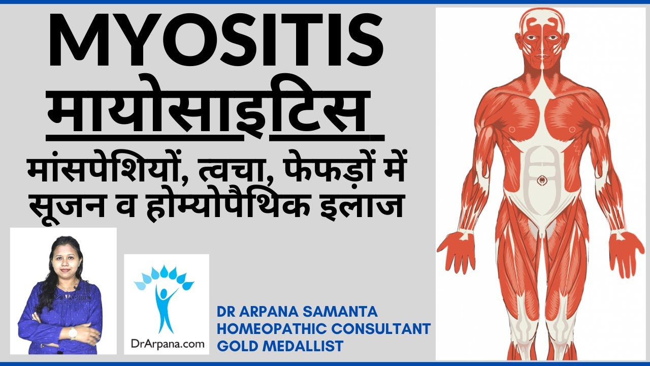 MYOSITIS मांसपेशियों, त्वचा, फेफड़ों में सूजन होम्योपैथिक दवा | MYOSITIS Causes Symptoms Homeopathy