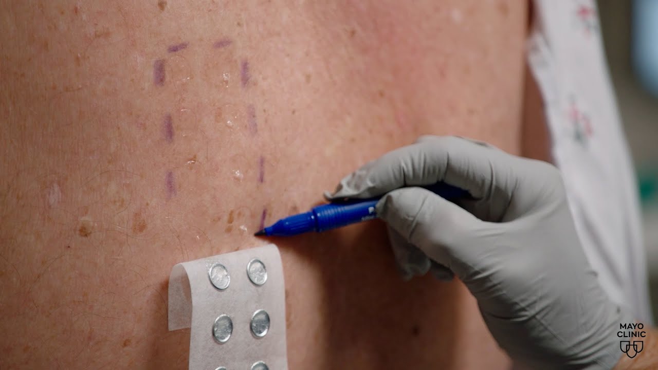 The future of skin allergy testing