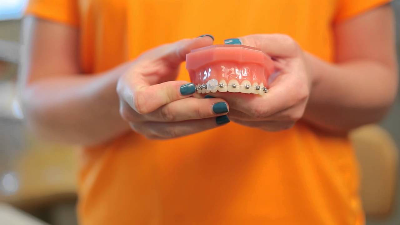 Orthodontist Denver Pro Talks About What To Do If You Get a Mouth Sore