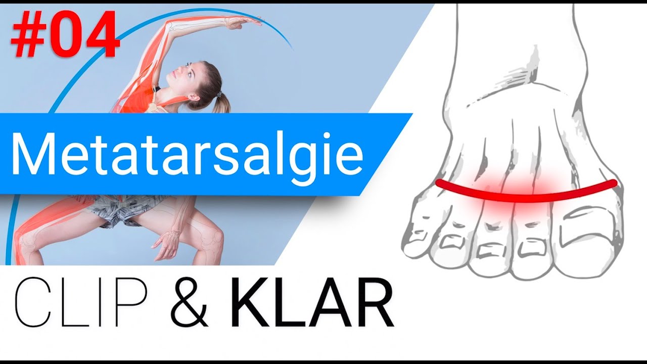 Metatarsalgie erkl&auml;rt - druckschmerzhafte Zehengrundgelenke