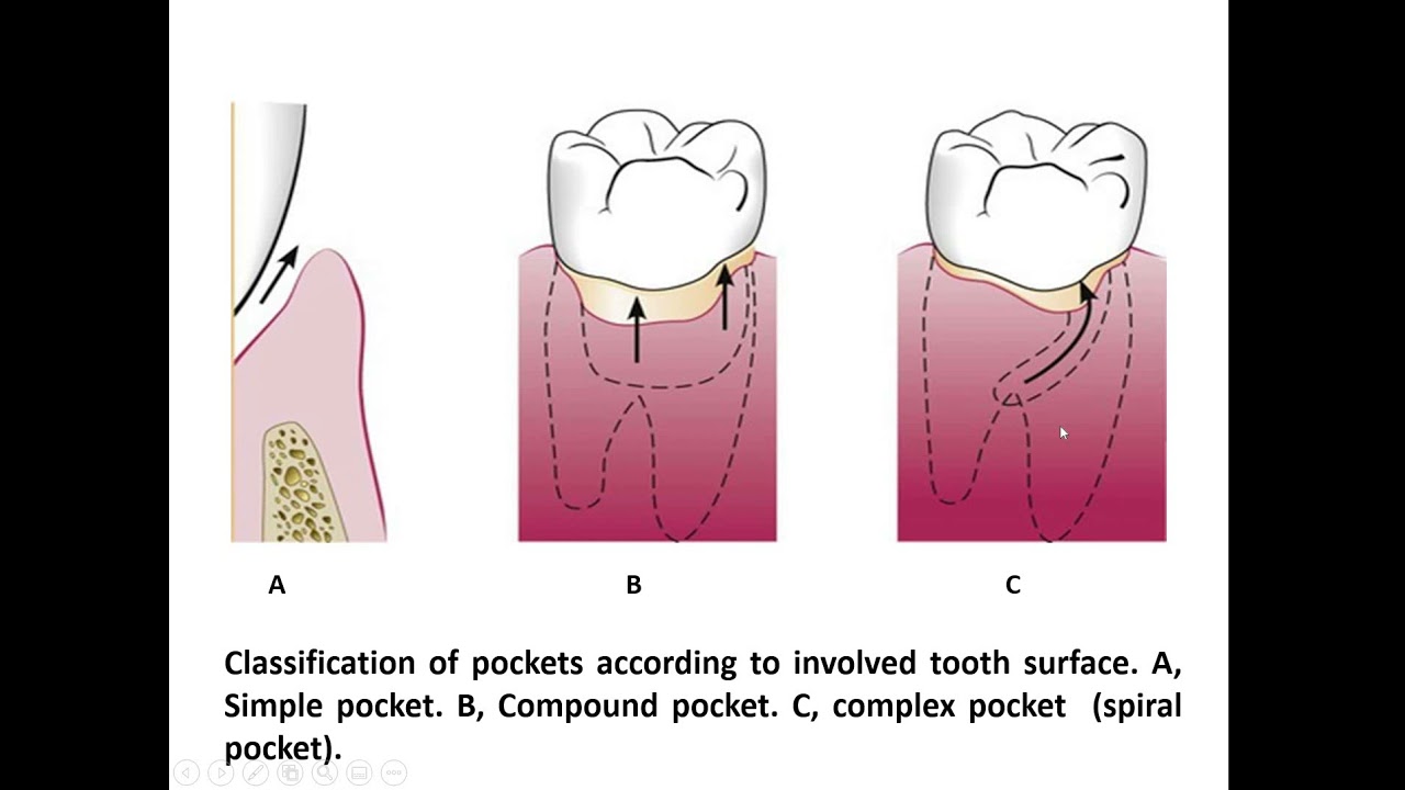 Periodontal Pocket   Dr Enas Elgendy
