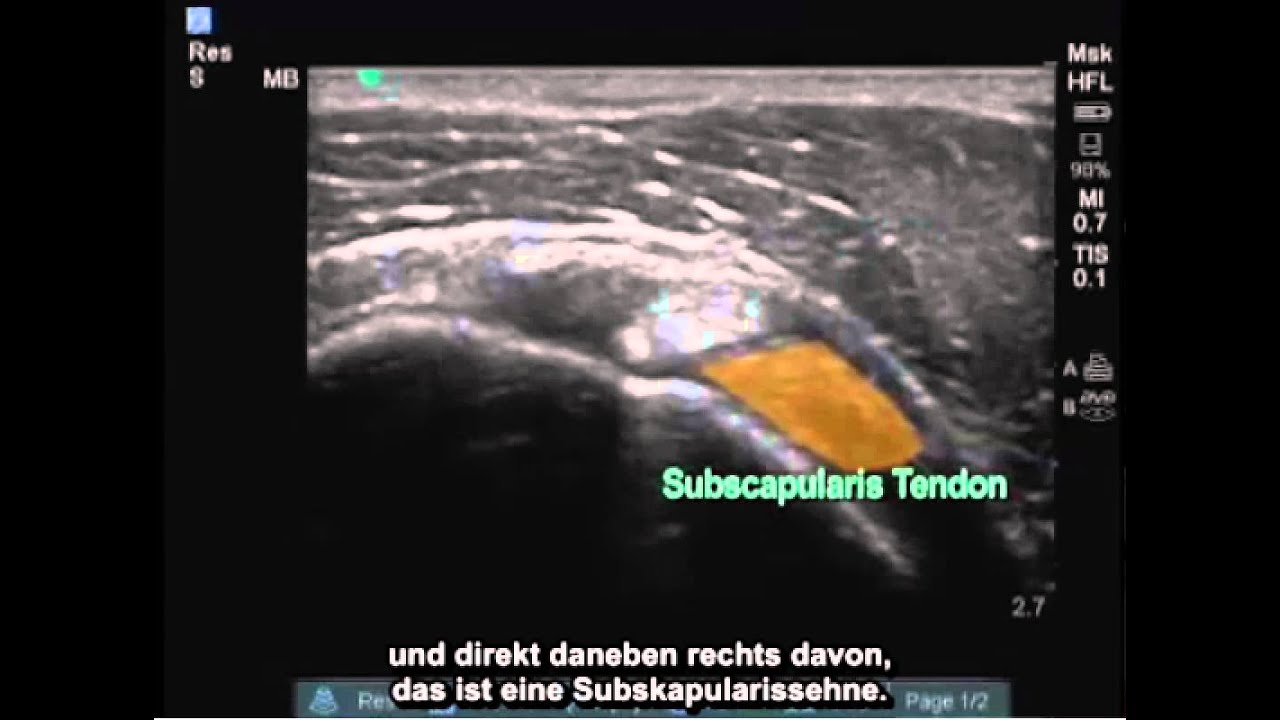 Anleitung: Ultraschalluntersuchung der Supraspinatussehne