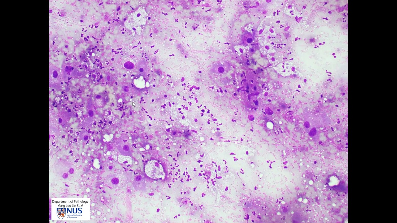 Thyroid cytology - Anaplastic thyroid carcinoma