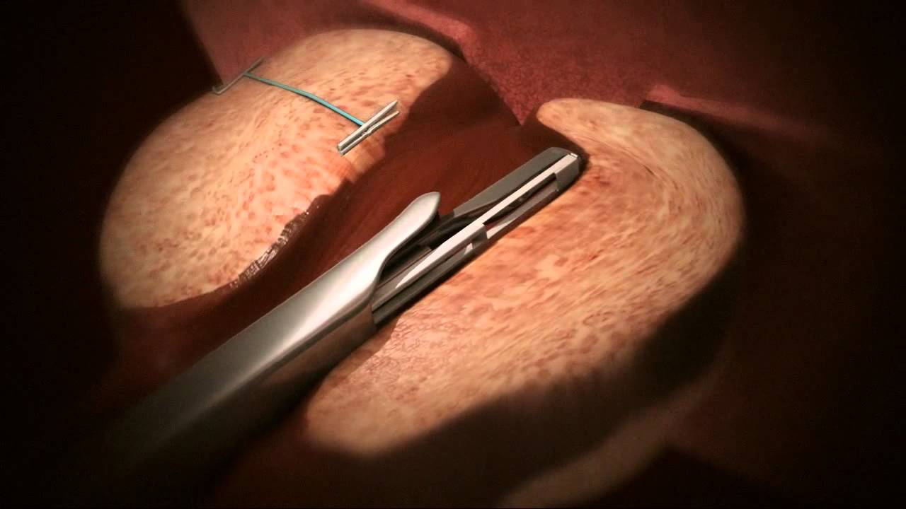 The UroLift&trade; System Animation in Norwegian