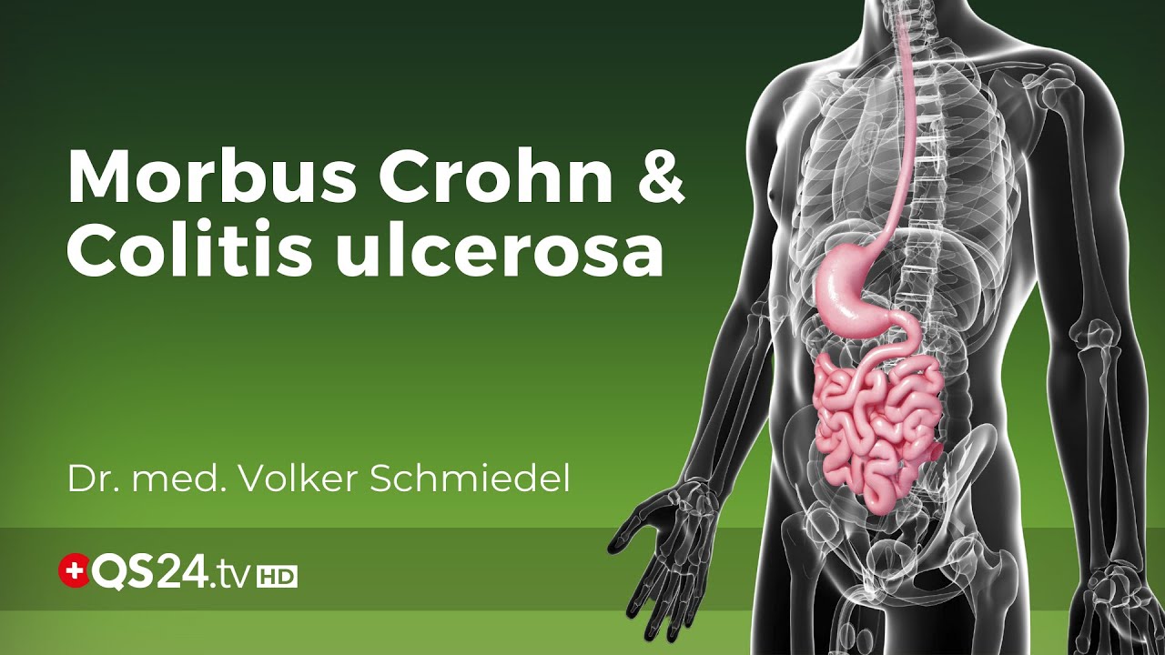 Morbus Crohn und Colitis ulcerosa - wirklich unbekannte Ursache? | Dr. med.  Schmiedel | QS24