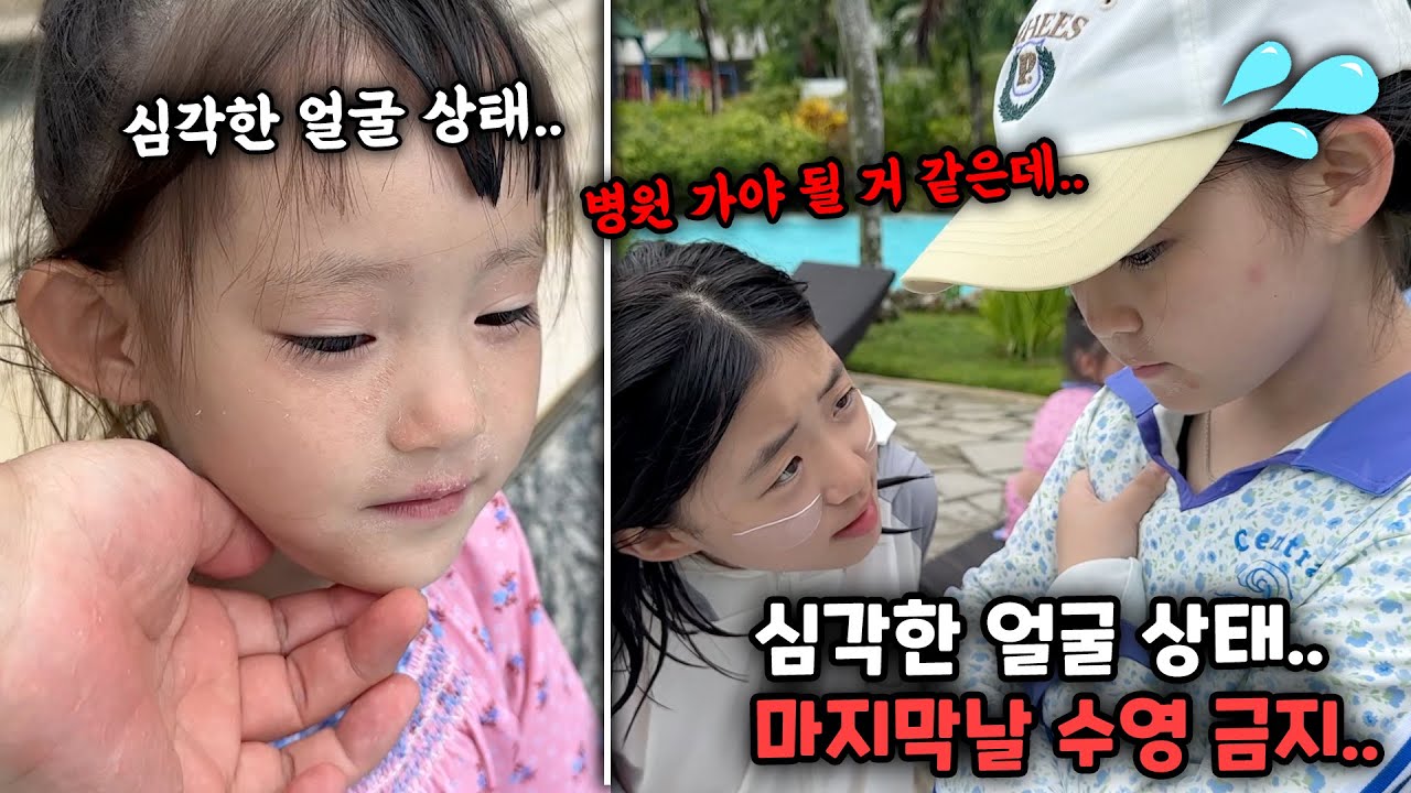심각한 얼굴 상태..마지막날 수영 금지까지..자매 둘다 얼굴이 많이 까졌어요.. (feat.괌 츠바키)