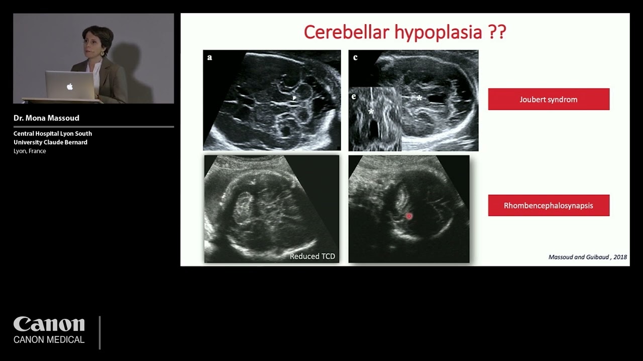 ISUOG 2022 - Dr. Mona Massoud - What's new about prenatal cerebellar hypoplasia?