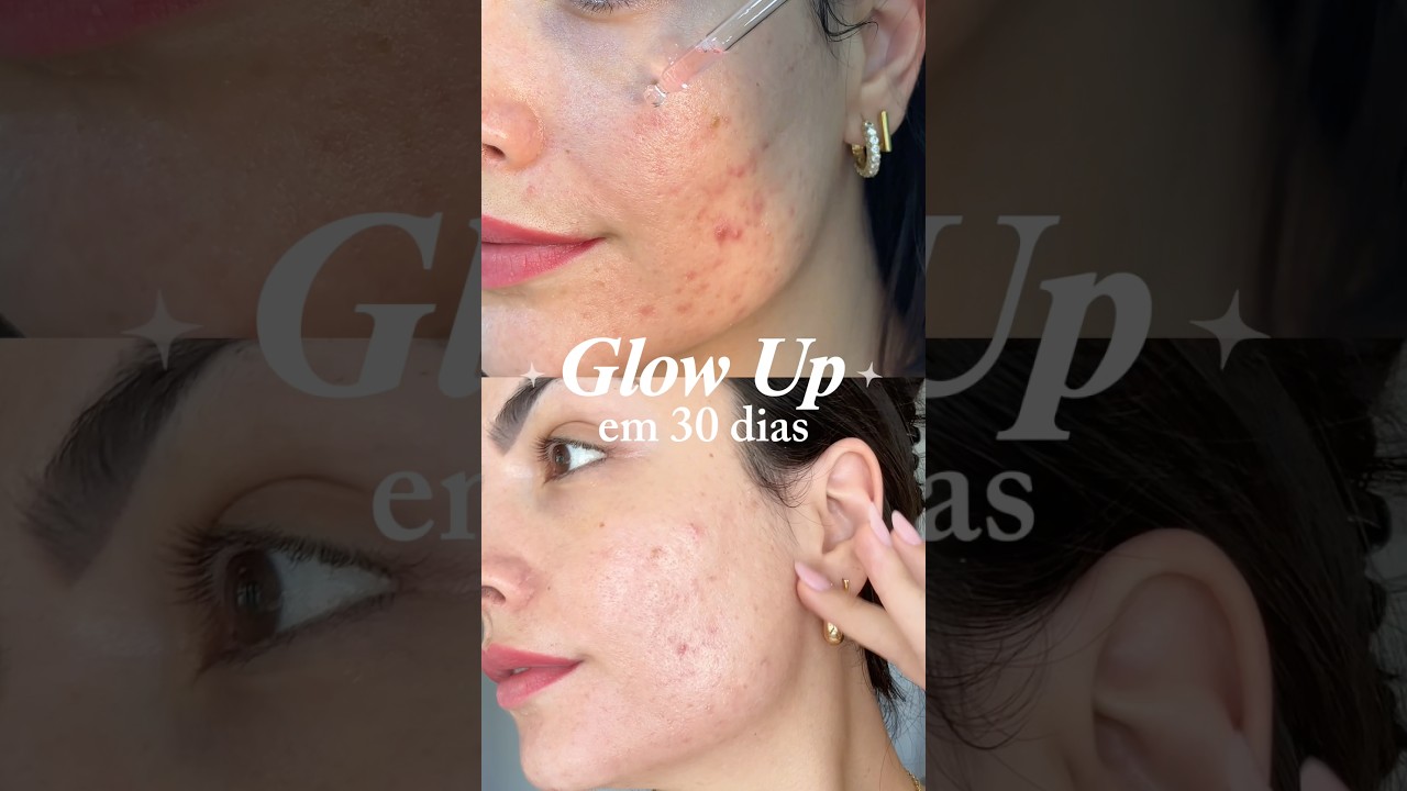 ANTES E DEPOIS DE RESPEITO COM ESSE GLOW UP que tive na pele em 20 dias!! #glowup #skincare