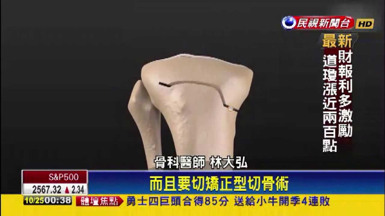 3D列印輔助骨科手術 重拾好膝力非難事－民視新聞