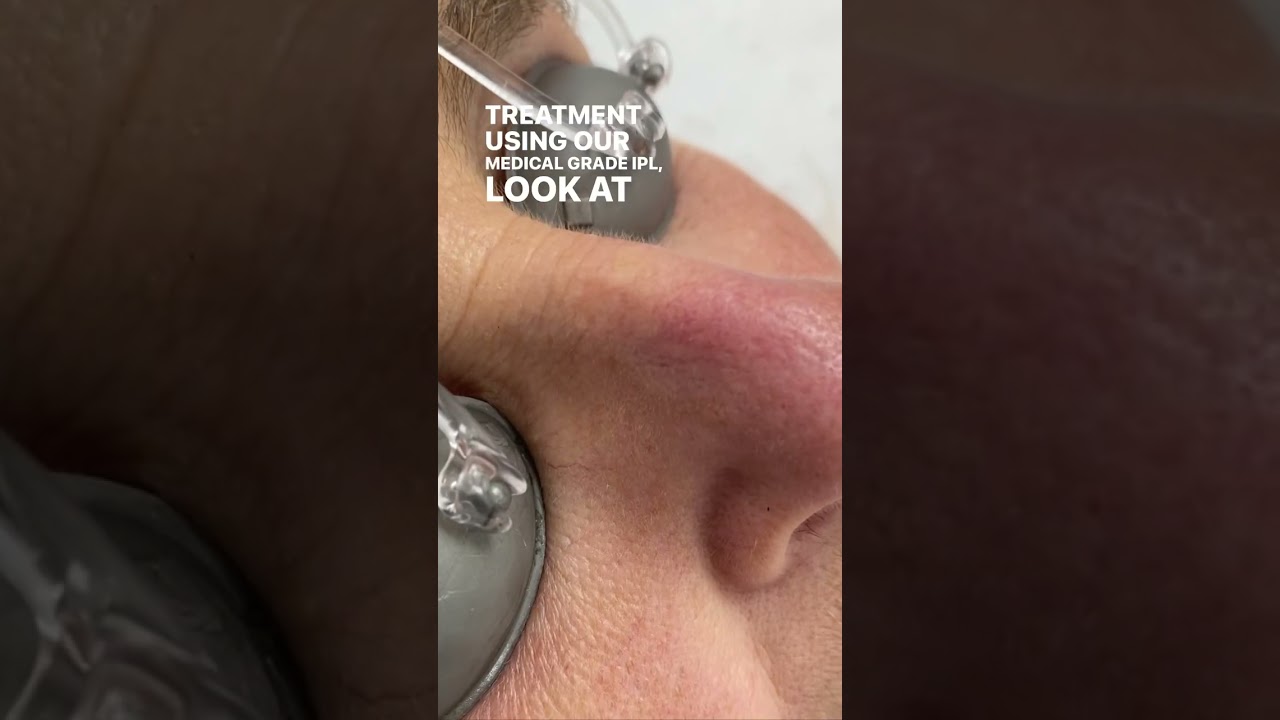 Red Vein Removal