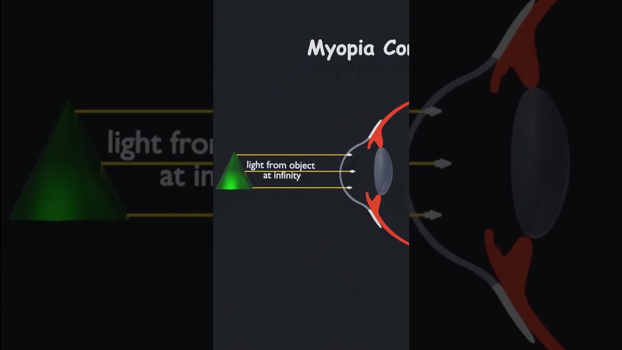Myopia correction | human eye defect | #physics #eye #animation #10thclass #nearsightedness #myopia