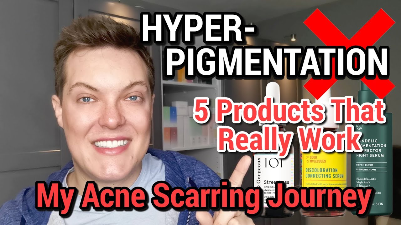 Top 5 Ways To FADE HYPERPIGMENTATION - These Actually Work