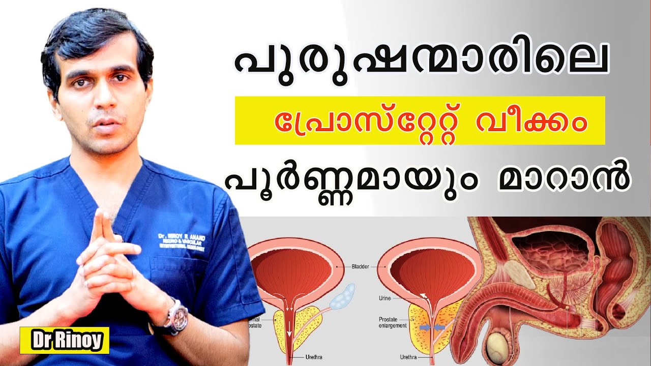 പുരുഷന്മാരിലെ പ്രോസ്റ്റേറ്റ് വീക്കം പൂർണ്ണമായും മാറാൻ /Dr Rinoy /prostate enlargement