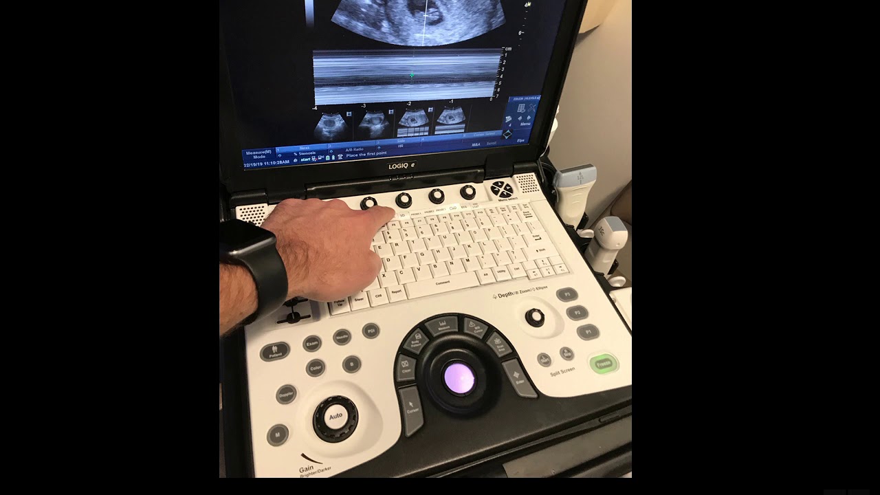 How to measure a FHB using M-Mode