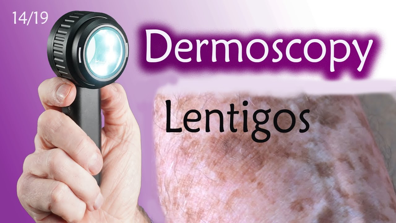 What are Lentigos? Why do we get them?